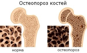 osteoporoz2