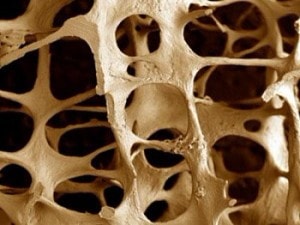 osteoporroz