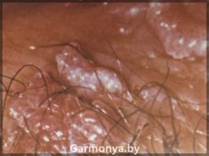 Доклад: Современные подходы к диагностике папилломавирусной инфекции гениталий у женщин