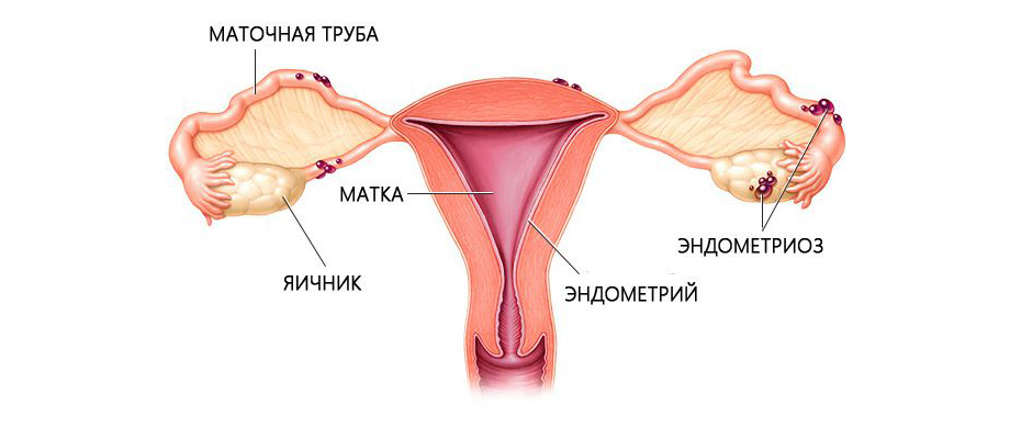 Лечение непроходимости маточных труб