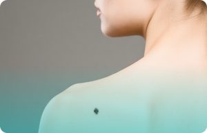 Родинка или меланома