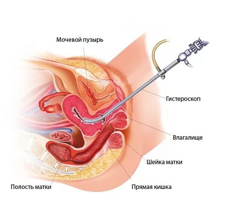 polip endometrium rák)